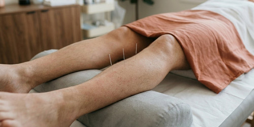 Séance d'acupuncture Angers - Sarrigné